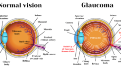 Glaucoma Complete Treatment