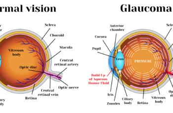 Glaucoma Complete Treatment